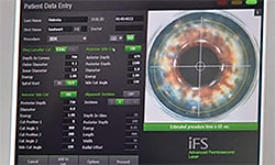IntraLase Femtosecond Laser-Assisted Keratoplasty